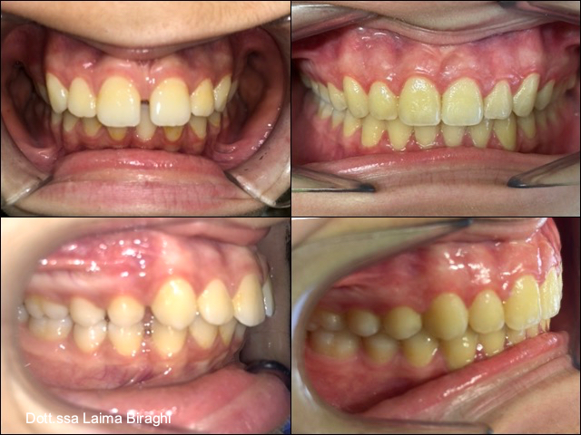 spazio tra i denti centrale