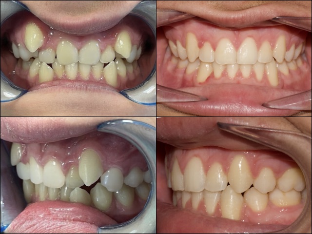 affollamento dentale prima e dopo