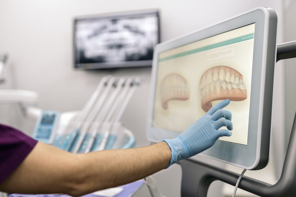 trattamento invisalign