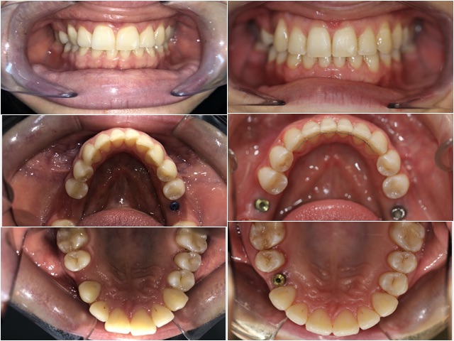 denti mancanti e apparecchio fisso