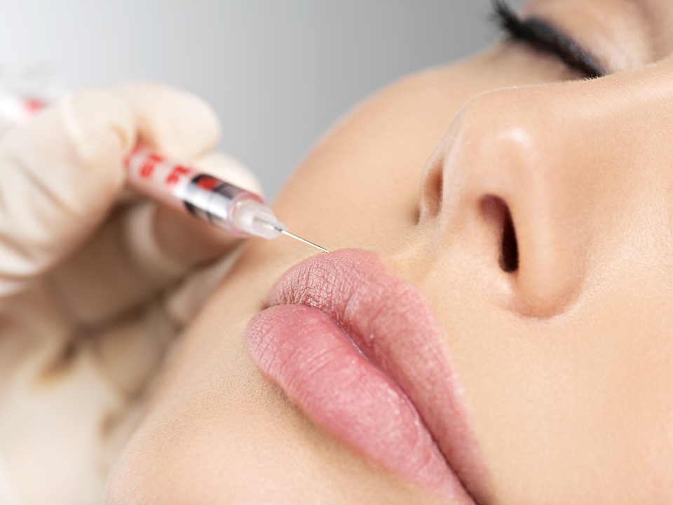 filler labbra effetto naturale