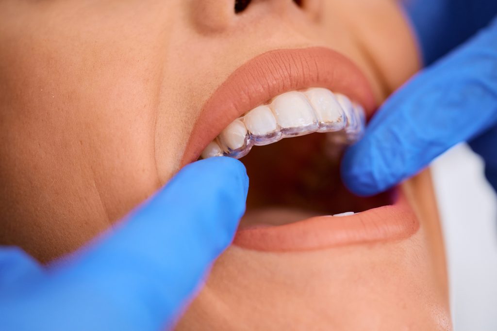 retainer trasparenti