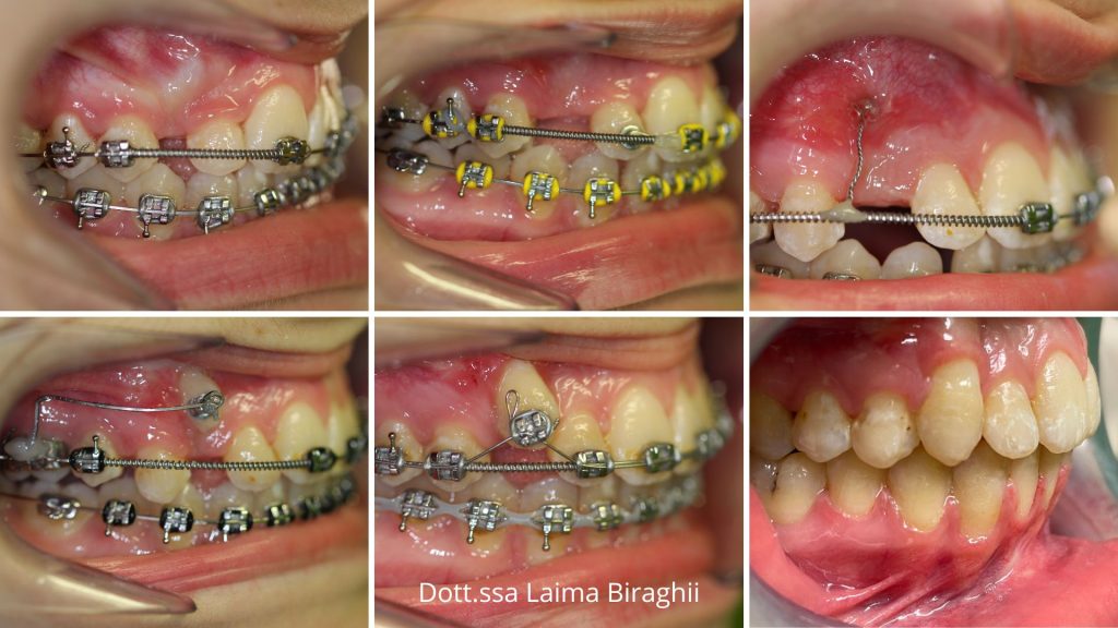inclusione dentale