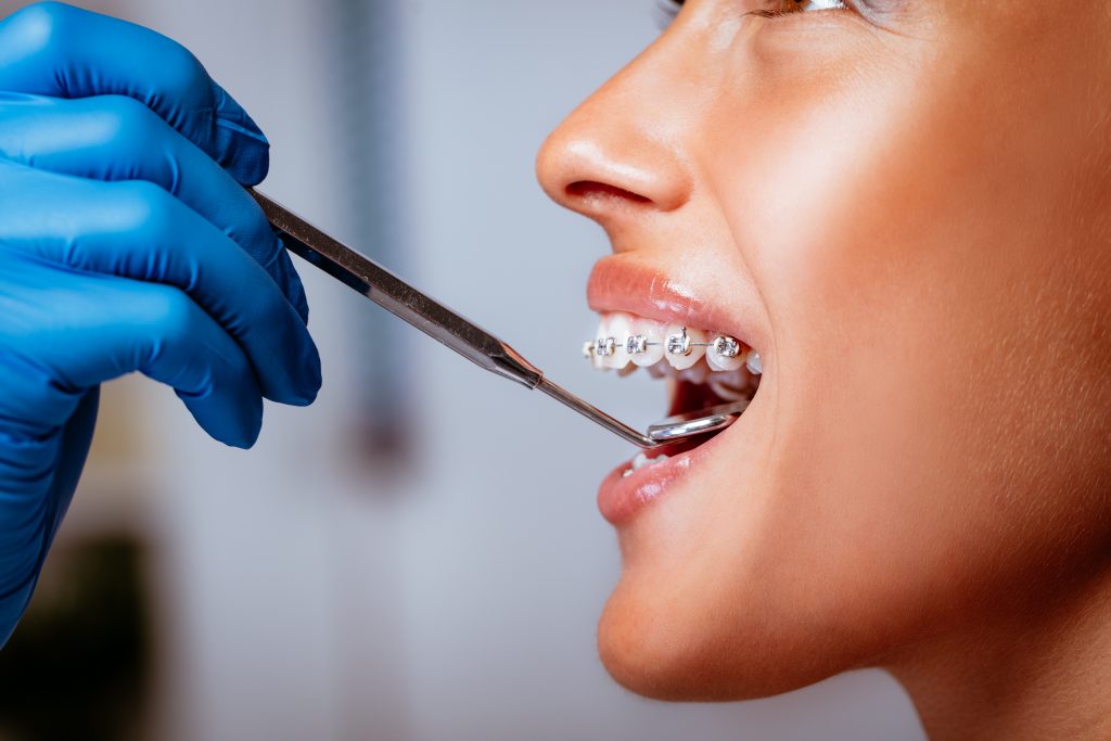 denti irregolari